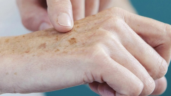 Software que auxilia na detecção de câncer de pele recebe prêmio internacional